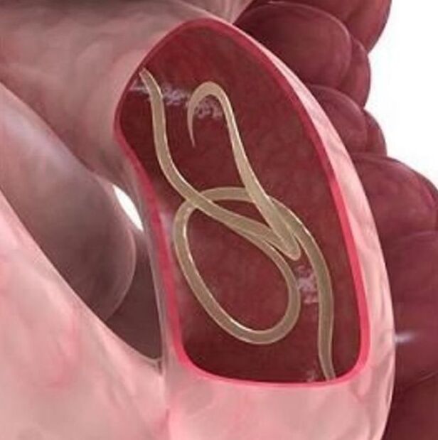 Mga timailhan sa mga ulod sa usa ka tawo sa gastrointestinal tract